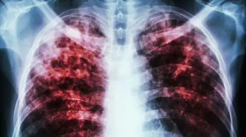 Hay registrados 162 casos de Tuberculosis en Tampico