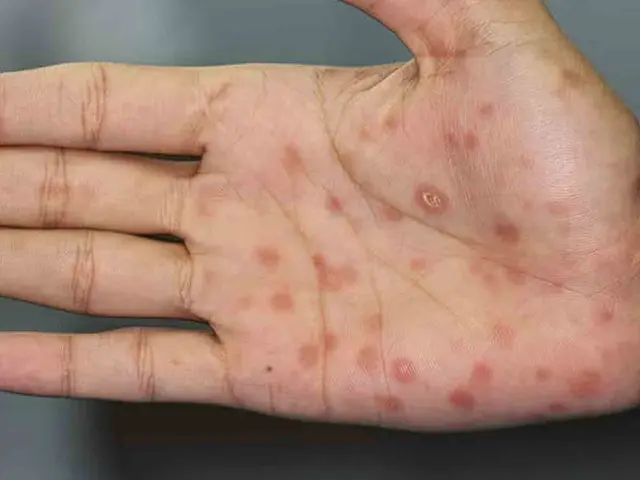 Se disparan los casos de sífilis; Jalisco y CDMX concentran la mayoría de contagios